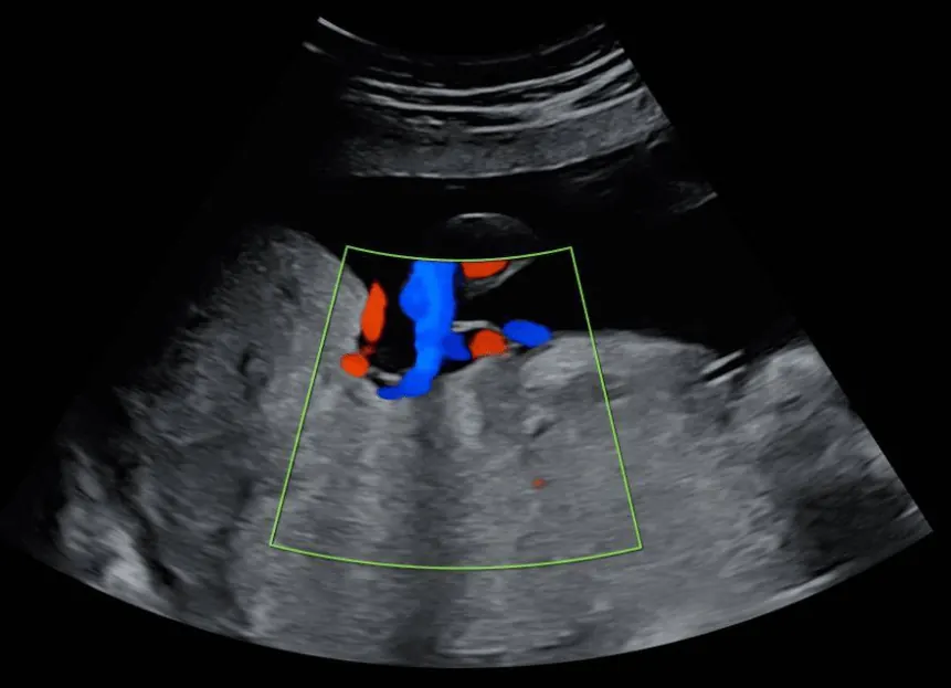Ultrassom obstétrico e Doppler na gestação